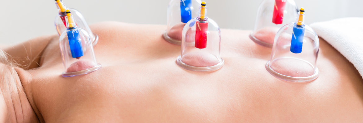 Cupping-therapy-treatment-portland